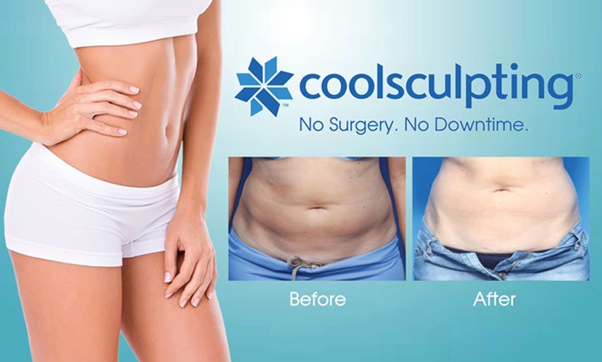Photo of Coolsculpting results