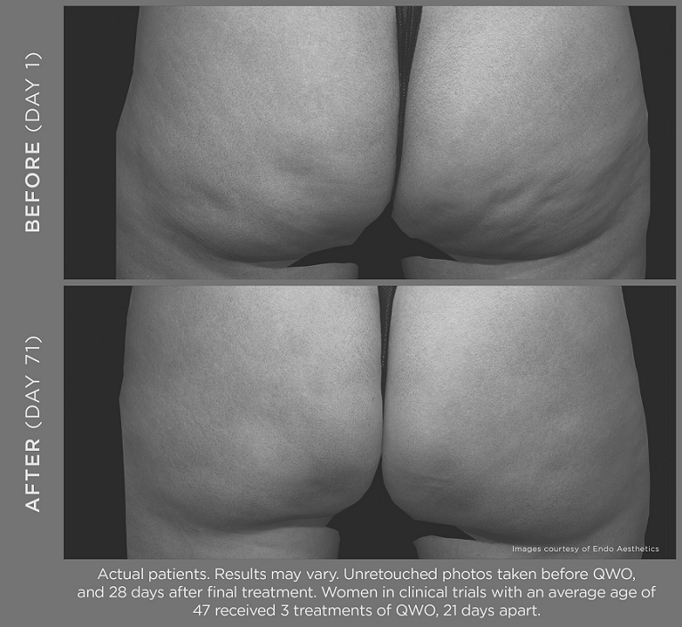 photo of buttocks before and after QWO treatment for cellulite