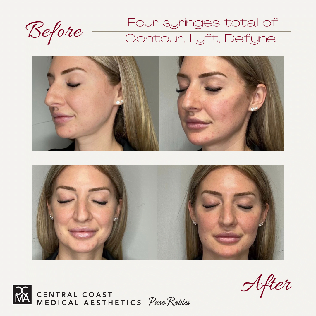 Before and after of Restylane treatments on face