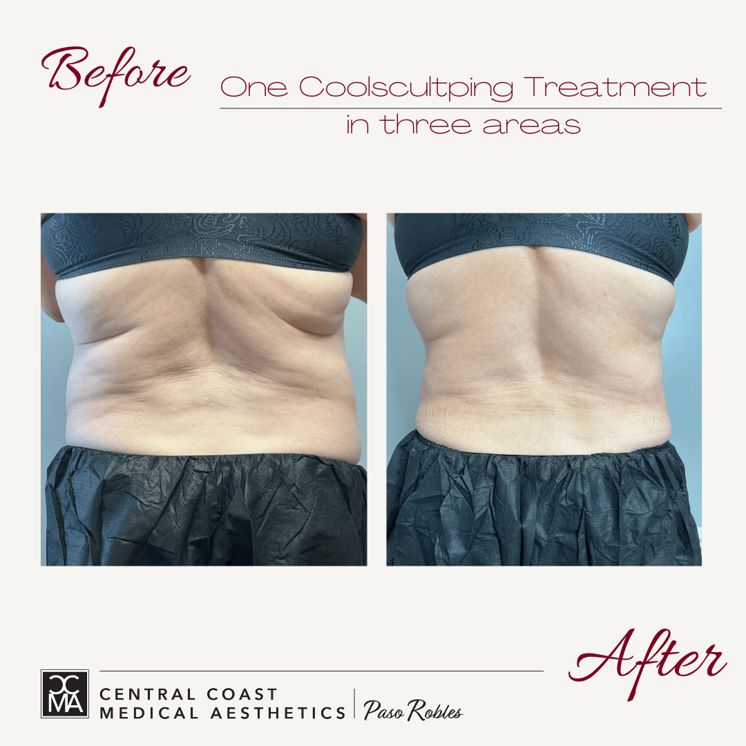 before and after coolsculpting treatment