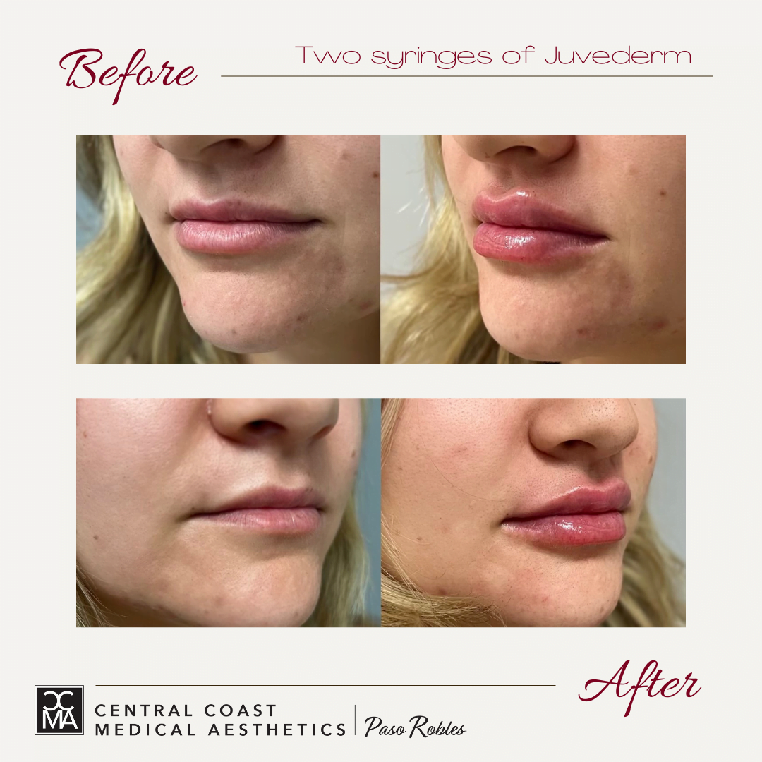 before and after of juvederm treatment on lips