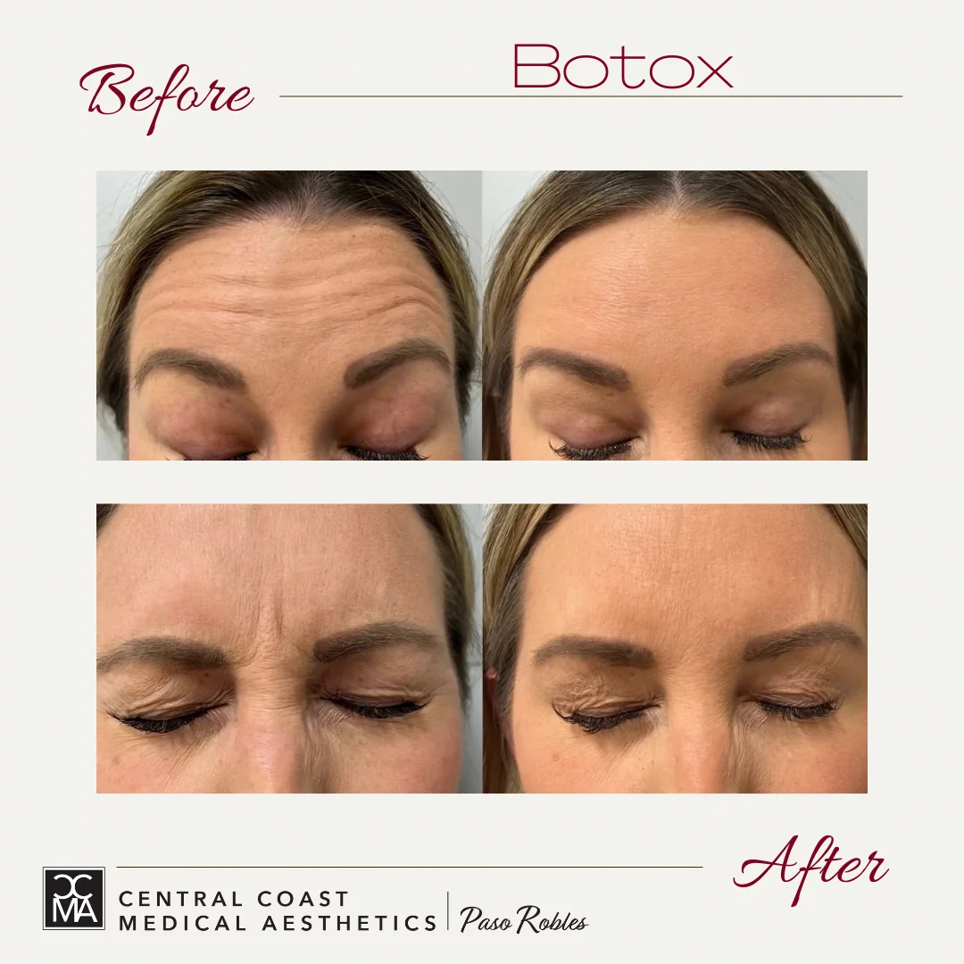 Botox before and after treatment