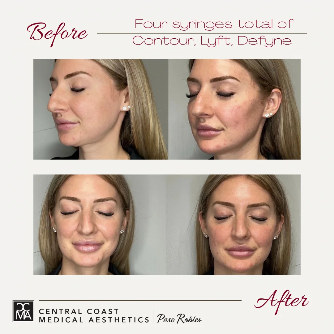 Before and after of Restylane treatments on face